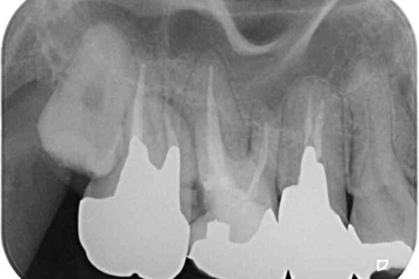 放置して悪化してしまったむし歯を早めに対応　セラミッククラウンによるむし歯治療 治療途中画像