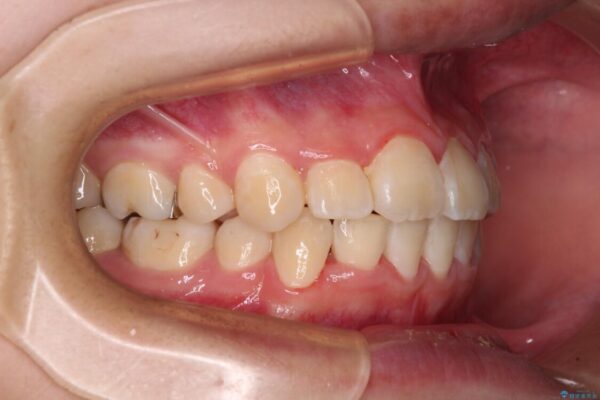 八重歯で正中が右にずれている　ワイヤー装置での抜歯矯正で正中位置を改善 治療後画像