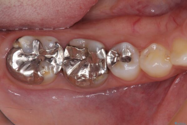 むし歯だらけの歯を治したい　インプラントを用いた補綴治療 治療前画像