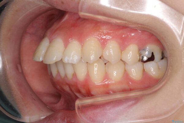 突出した口元が気になる　ハーフリンガル装置による抜歯矯正 治療前画像