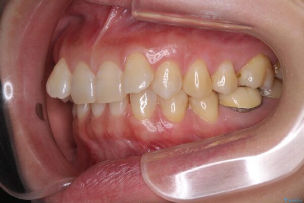 下顎2前歯の欠損　インビザラインによる抜歯矯正 治療前画像