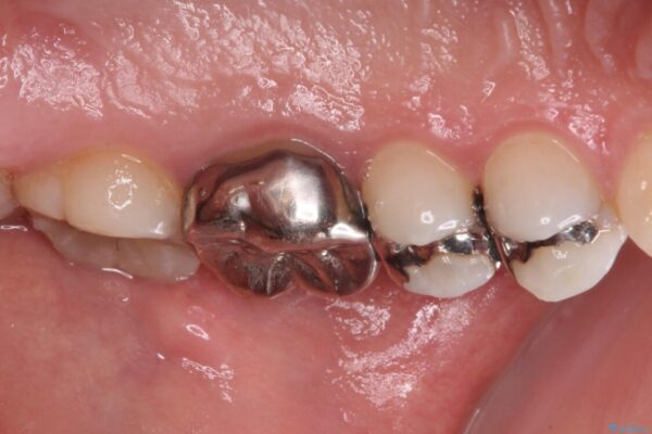 目立つ銀歯を白くしたい　奥歯のセラミック治療 治療前画像
