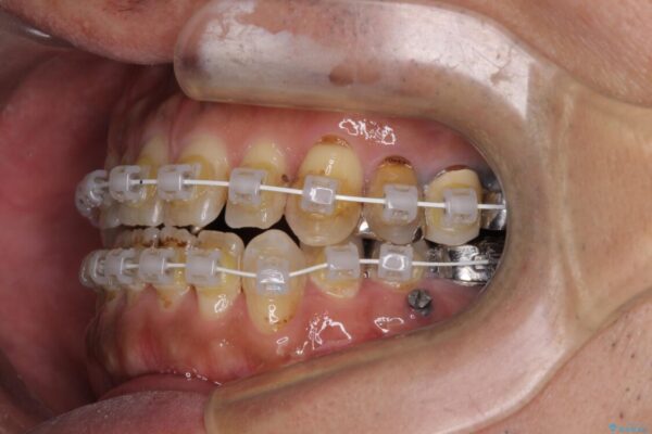 前歯の反対咬合をワイヤー矯正で改善して噛みやすく 治療途中画像