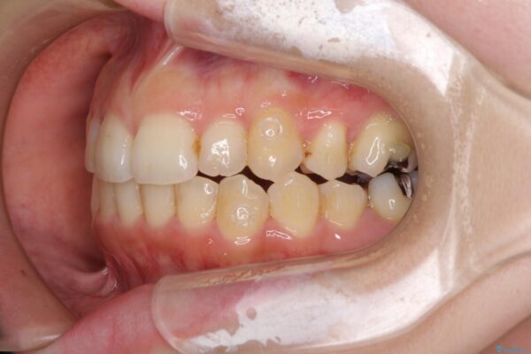 顕著な八重歯をインビザラインで治せるところまで改善 治療途中画像