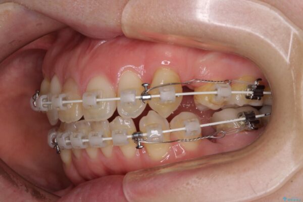 抜歯矯正で閉じにくかった口を閉じやすく改善 治療途中画像