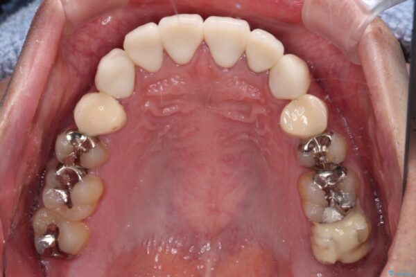 むし歯の影響で、前歯を見せることが恥ずかしいとのことで来院された患者様です。 治療後画像