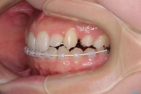 目立つ八重歯を目立たない装置で　ハーフリンガルによる抜歯矯正 治療途中画像