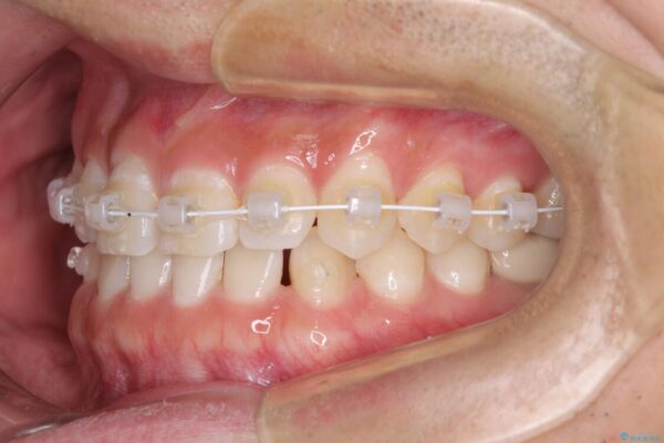 隙間の空いた前歯を治したい　上顎の部分矯正 治療途中画像