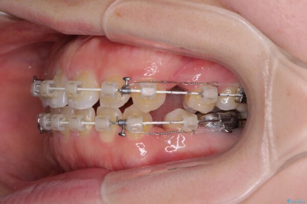 膨らんだ口元が気になる　ワイヤー装置による抜歯矯正 治療途中画像