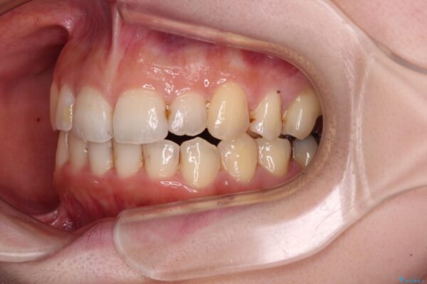 顕著な八重歯をインビザラインで治せるところまで改善 治療後画像