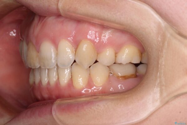 抜歯矯正で閉じにくかった口を閉じやすく改善 治療後画像