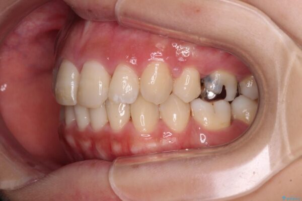 突出した口元が気になる　ハーフリンガル装置による抜歯矯正 治療後画像