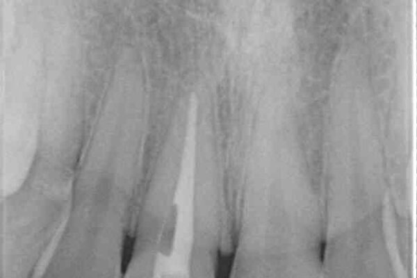 茶色になった前歯　オーダーメイドタイプのオールセラミッククラウン 治療前画像