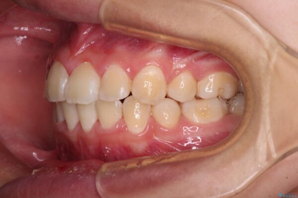 八重歯で正中が右にずれている　ワイヤー装置での抜歯矯正で正中位置を改善 治療後画像