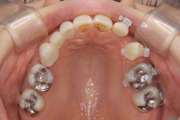 欠損の多い歯列　部分矯正とセラミックブリッジで自然な見た目に 治療途中画像