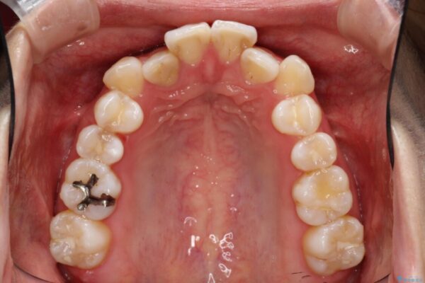 目立たないハーフリンガル矯正　抜歯矯正で口元を改善 治療前画像