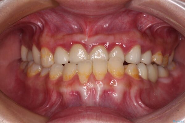 むし歯だらけの奥歯　セラミッククラウンによるむし歯治療 治療後画像