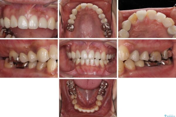 以前治療した歯が続々とむし歯に　全顎むし歯治療 ビフォー