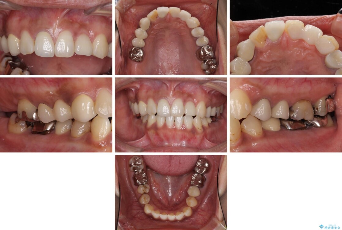以前治療した歯が続々とむし歯に　全顎むし歯治療 治療前