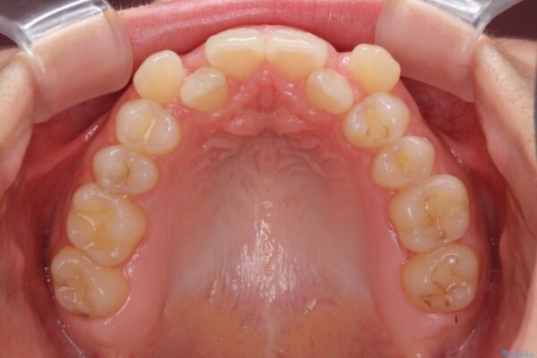 目立つ八重歯を目立たない装置で　ハーフリンガルによる抜歯矯正 治療前画像