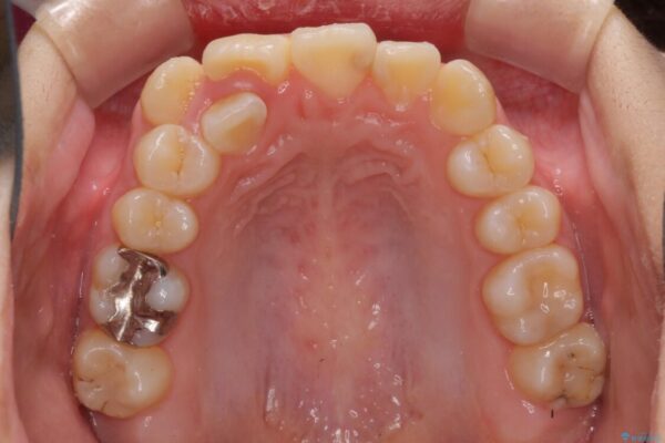 八重歯で正中が右にずれている　ワイヤー装置での抜歯矯正で正中位置を改善 治療前画像