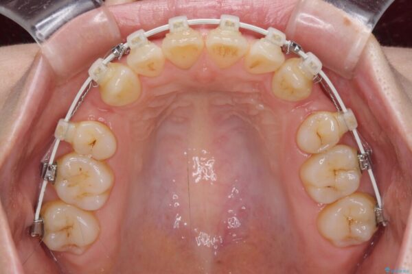 抜歯矯正で閉じにくかった口を閉じやすく改善 治療途中画像