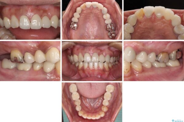 以前治療した歯が続々とむし歯に　全顎むし歯治療 治療後画像