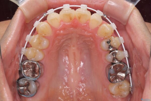 咬み合わせが気になる　ワイヤー矯正による咬み合わせ改善と奥歯のセラミック治療 治療途中画像