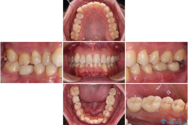 抜歯が必要な奥歯　ストローマン・インプラント補綴治療 治療後画像