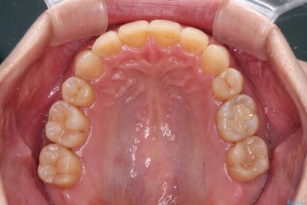 下顎2前歯の欠損　インビザラインによる抜歯矯正 治療後画像