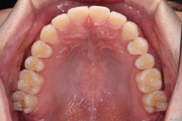 隙間の空いた前歯を治したい　上顎の部分矯正 治療後画像