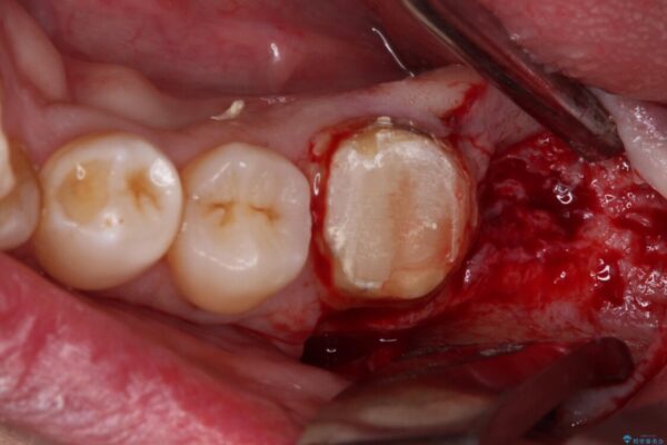 抜歯が必要な奥歯　ストローマン・インプラント補綴治療 治療前画像