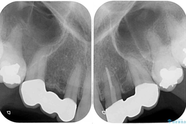 欠損の多い歯列　部分矯正とセラミックブリッジで自然な見た目に 治療後画像