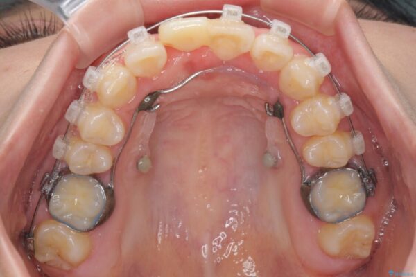 怪我をして不格好な前歯　矯正治療とインプラント補綴治療 治療途中画像