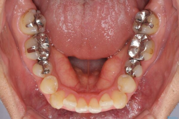 咬み合わせが気になる　ワイヤー矯正による咬み合わせ改善と奥歯のセラミック治療 治療前画像