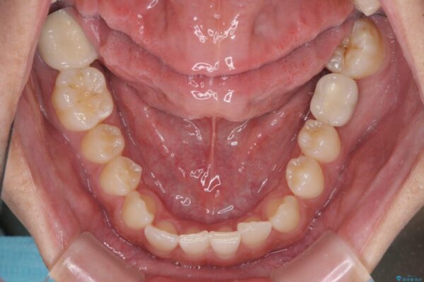 隙間の空いた前歯を治したい　上顎の部分矯正 治療前画像