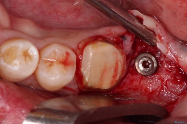 抜歯が必要な奥歯　ストローマン・インプラント補綴治療 治療途中画像