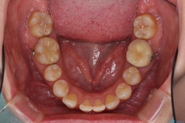 下顎2前歯の欠損　インビザラインによる抜歯矯正 治療途中画像