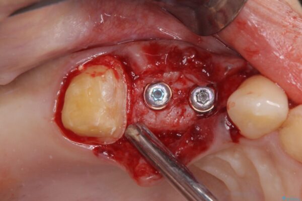 むし歯だらけの歯を治したい　インプラントを用いた補綴治療 治療途中画像