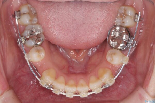 膨らんだ口元が気になる　ワイヤー装置による抜歯矯正 治療途中画像