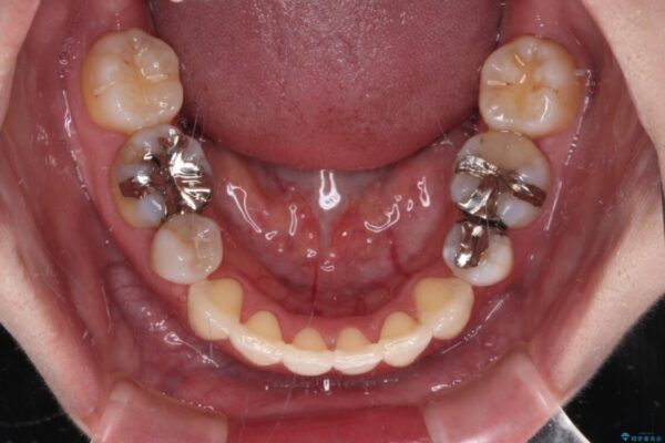 目立たないハーフリンガル矯正　抜歯矯正で口元を改善 治療後画像