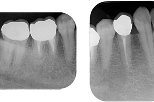 以前治療した歯が続々とむし歯に　全顎むし歯治療 治療後画像
