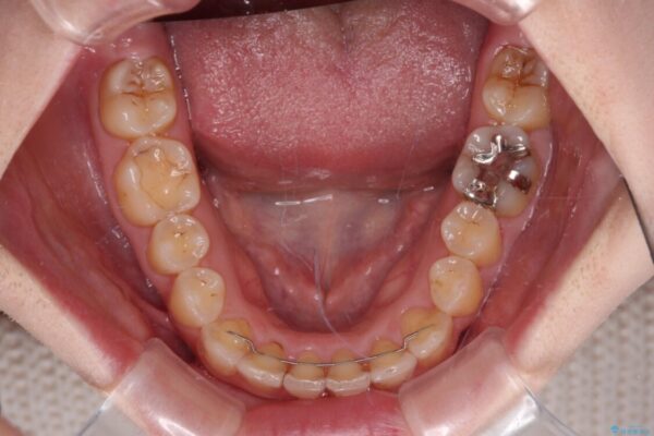 顕著な八重歯をインビザラインで治せるところまで改善 治療後画像