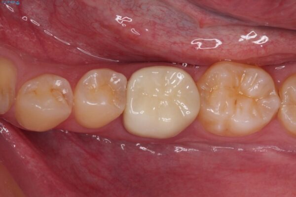 奥歯の被せものが汚れやすい　仮歯のままの歯をセラミッククラウンに アフター