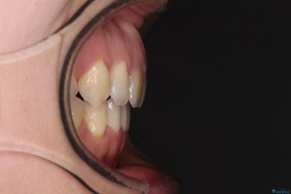 抜歯矯正で閉じにくかった口を閉じやすく改善 治療後画像
