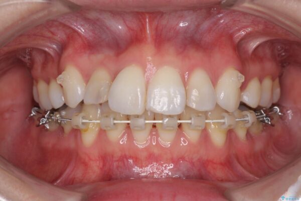 目立たないハーフリンガル矯正　抜歯矯正で口元を改善 治療途中画像