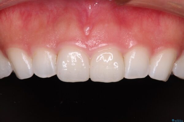 前歯の形を変えたい　前歯のラミネートベニア治療 アフター