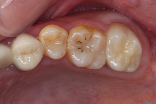 むし歯だらけの奥歯　セラミッククラウンによるむし歯治療 治療後画像