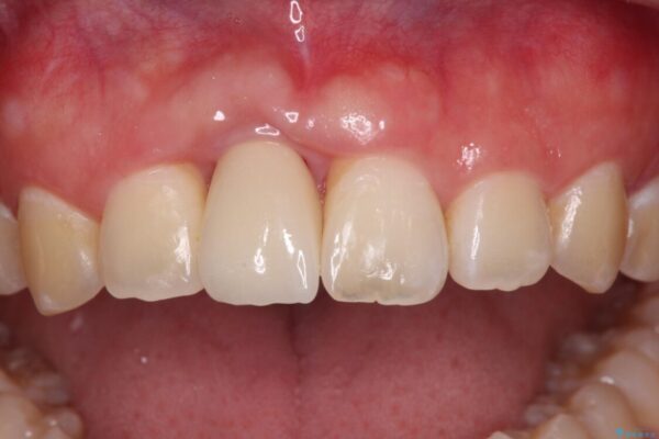 怪我をして不格好な前歯　矯正治療とインプラント補綴治療 アフター