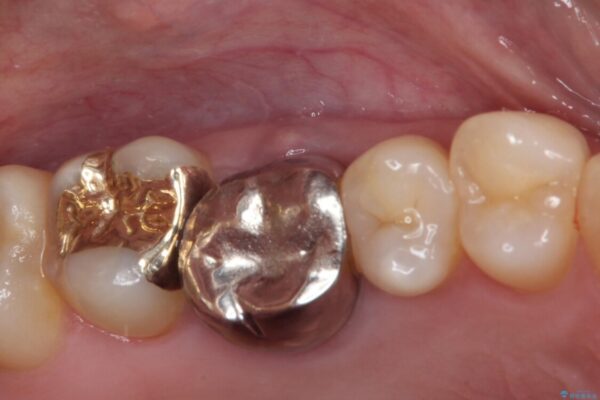 穴の空いてしまった奥歯　ゴールドインレーによるむし歯治療 治療後画像